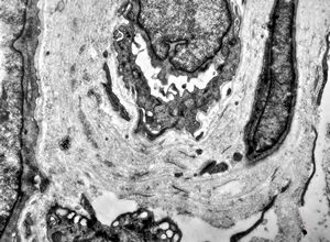 F, 48y. | lupus erythematodes … multiplicated vascular basement membrane F, 48y. | lupus erythematodes … multiplicated vascular basement membrane